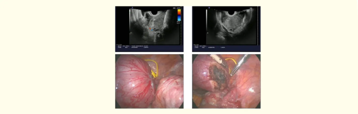 Figure 5:  Cornual wedge resection. Ultrasound and operative findings.