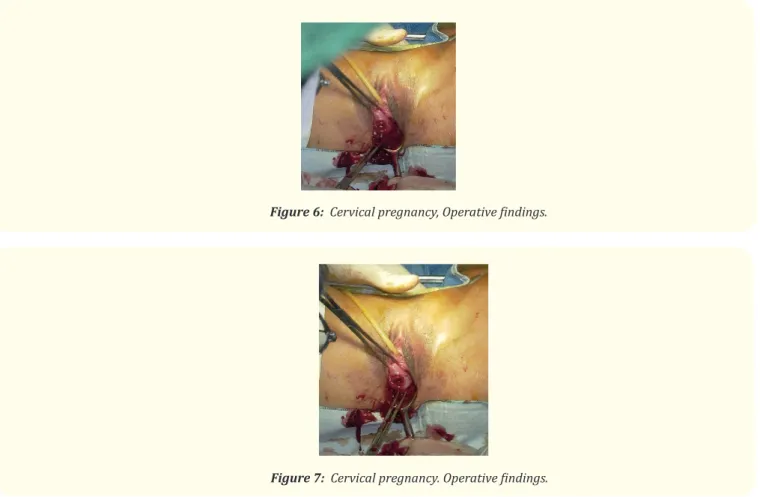 Figure 6:  Cervical pregnancy, Operative findings.