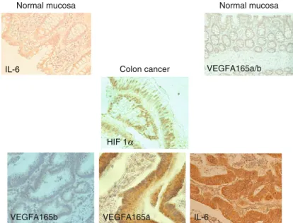 Fig. 2 HIF-1 , IL-6, and VEGF-A165 in colon cancer.