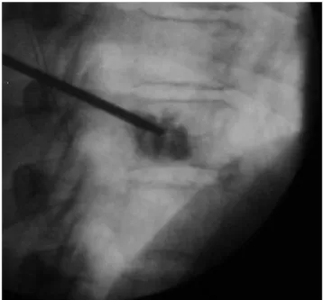 Figure 1. Needle electrode tip deployed (white arrow) into the central part of the lesion, generates a well-defined area of tumor necrosis.
