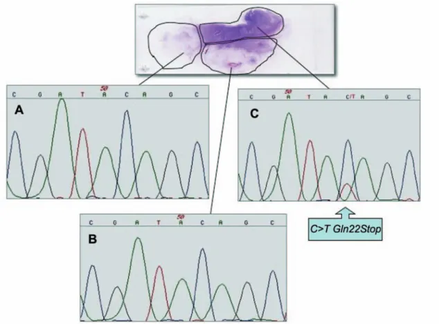 Figure 1. Sequence analysis of the K-ras exon 1 performed on DNA extracted from each microdissected area of paraffin-embedded tumor sections.