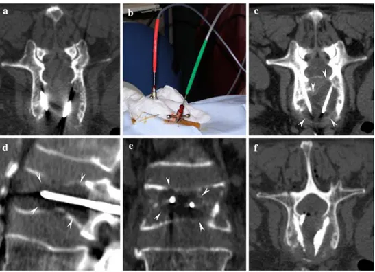 Fig. 1. (A) Axial image showing positioning of the 13G biopsy needles under CT control