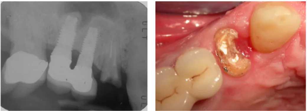 Figure 1: Case 1: clinical and radiographic evaluation before the extraction.