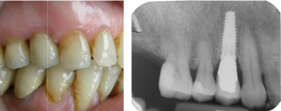 Figure 10: Case 2: definitive prosthetic restoration with periapical radiograph.