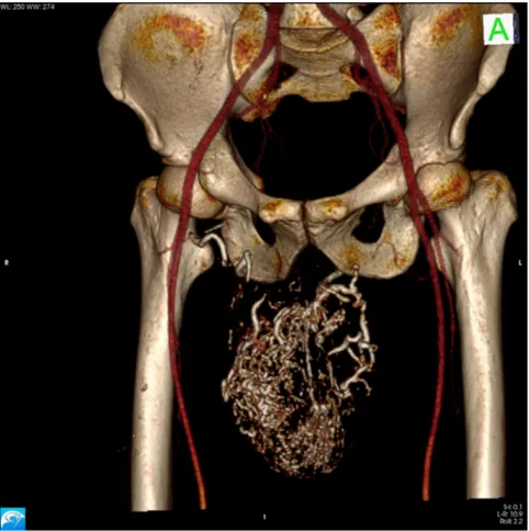 Fig. 2. Angio-CT SSD reconstruction swowing normal vasculararisation of the iliofemoral area and the selective embolisation with Glue deposition in the A-V malformation and in the arterial ramiﬁcations coming from the right femoral artery.