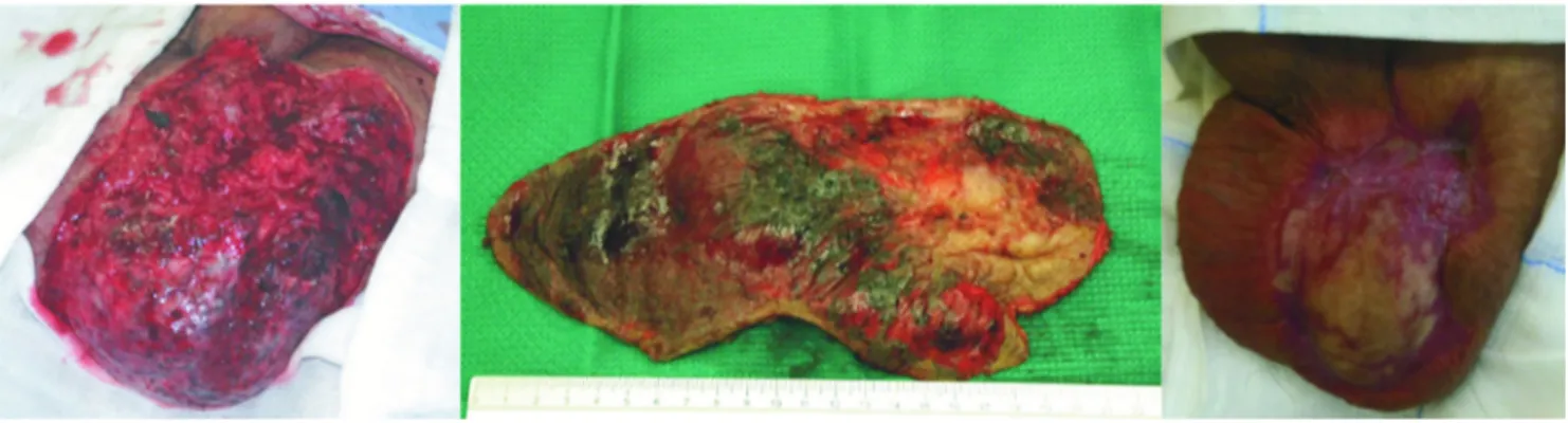 Fig. 3. A. Right hemiscrotum aspect after necrotic tissue asportation. B. Necrotic skin tissue removed
