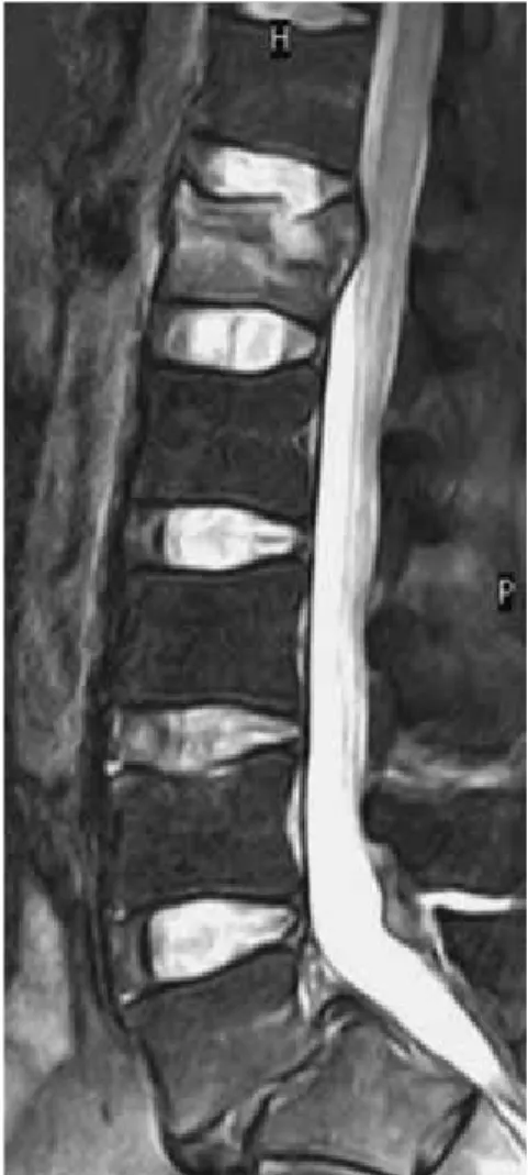 Fig. 1 A 64-year-old osteoporotic woman. Series of images acquired with the spectral selection attenuated inversion recovery (SPAIR) technique to suppress the fat tissue signal