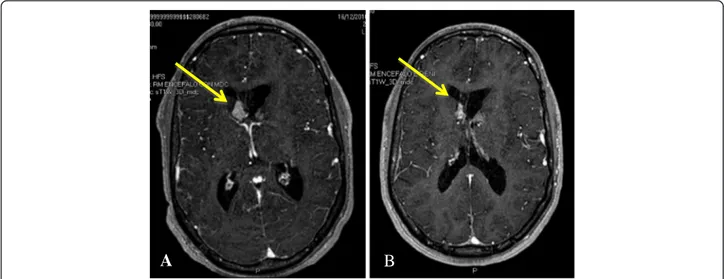 Figure 1 SEGA volume reduction during Everolimus treatment. A boy with a TSC2 mutation showed progressively growing SEGAs that caused a first acute hydrocephalus when he was 17 years old