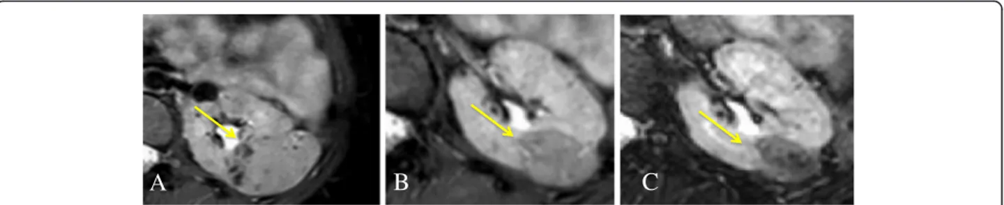 Figure 3 Progressive reduction of renal AMLs. A girl with a TSC2 mutation presented renal AMLs since childhood, with no impairment of renal function but with a progressivre growth both in number and in size