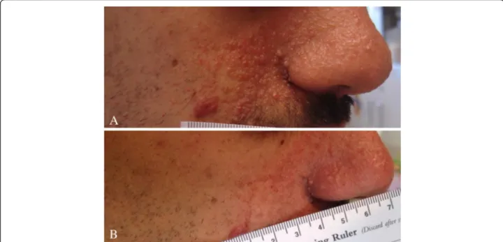 Figure 4 Facial angiofibroma before and during Everolimus treatment. Facial angiofibroma of the same boy presented in Figure 1 at baseline (A) and after 84 weeks of treatment with Everolimus (B).