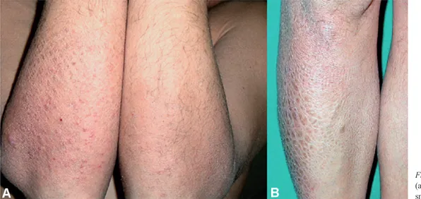 Fig. 1. Ichthyosiform appearance on  (a) the arms, with limited irregular  small papules, (b) and legs.