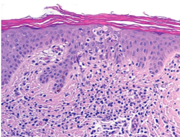 Fig. 2. Combined histological features of acquired ichthyosis (orthokeratotic  hyperkeratosis, mild acanthosis and thinned granular layer) and  epidermo-tropic lymphomatous infiltration (lymphocytes exocytosis in the basal layer,  small  epidermal  lymphoc