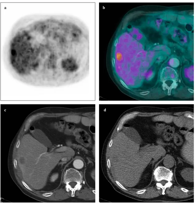 Fig. 2a-d A 75-year-old man affected by a metastasis in hepatic segment V. The axial (a) 2-[fluorine-18] fluoro-2-deoxy-D-glucose positron emission tomography ( 18 F-FDG-PET) image and (b) the fusion PET contrast-enhanced computed tomography (CT) images sh