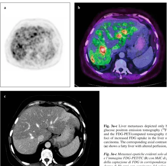 Fig. 3a-c Liver metastases depicted only by 2-[fluorine-18] fluoro-2-deoxy-D- fluoro-2-deoxy-D-glucose positron emission tomography ( 18 F-FDG-PET)
