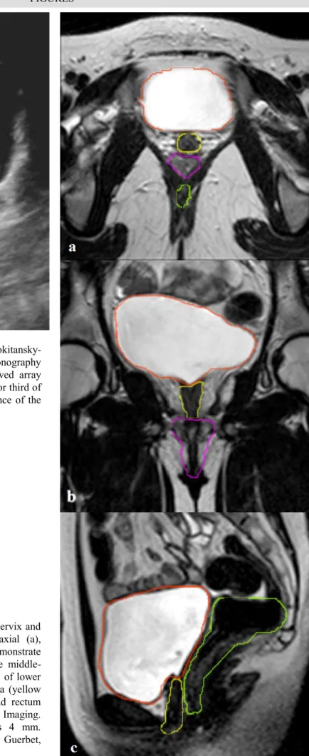 Figure 2 (right): 16 year old girl with absence of cervix and  uterus  in  MRKH  syndrome