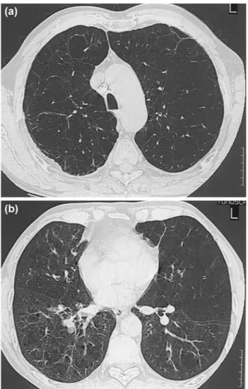Fig. 1. High resolution CT scans showing heterogeneous emphysema. (a) ES: left  4; right  4