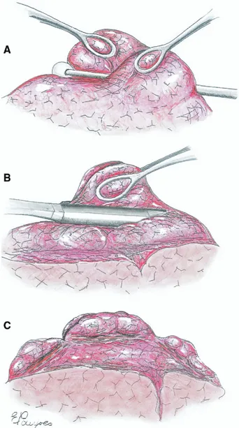 Fig 1. Main operative steps of awake nonresectional lung volume reduction surgery. (A) The most emphysematous lung region targeted for plication is depressed by a cotton swab while the lung edges are grasped by two ring forceps