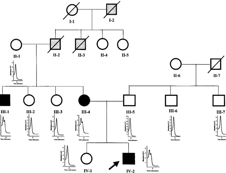 Figure 1. Pedigree of the family with PAPA syndrome. DHPLC profiles of exon 10 of CD2BP1 gene are shown for individuals in whom analysis was performed