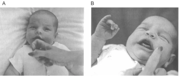 Figura 1.8: Esempio di riflesso di suzione (A) e riflesso dei punti cardinali (B). Tratto da Payne e Isaacs, 2005 [129].