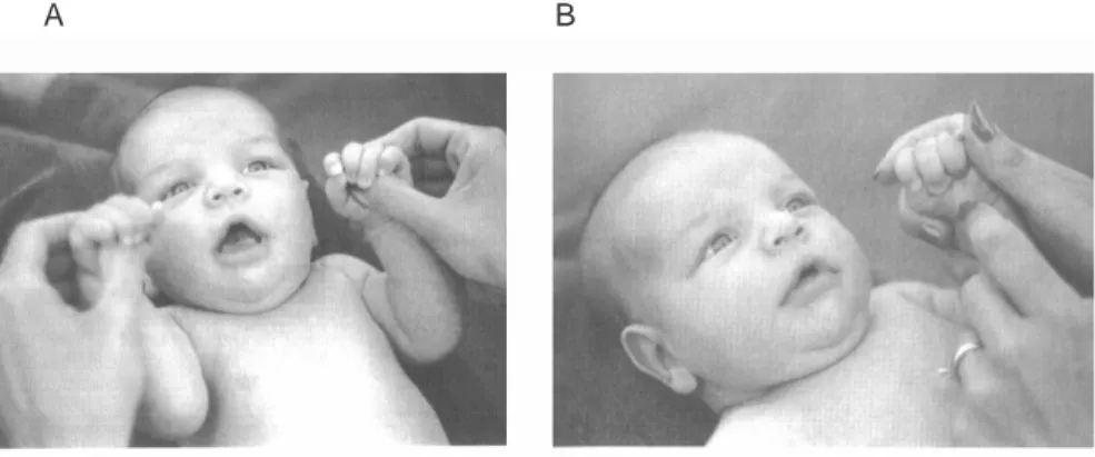 Figura 1.13: Esempio di riflesso palmo-mento e palmo-mandibola. Tratto da Payne e Isaacs, 2005 [129].