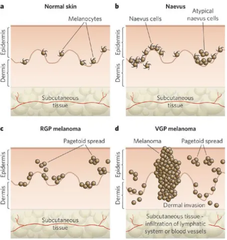 Figure  1.4.  The  Clark  model:  progression  of  melanocyte  transformation  (Gray- (Gray-Schopfer et al