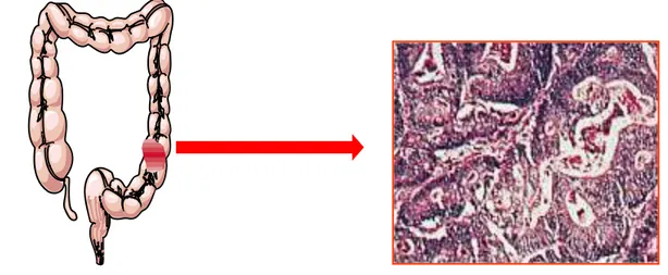 Figure 1. Morphological and histological scheme of CRC lesion. 