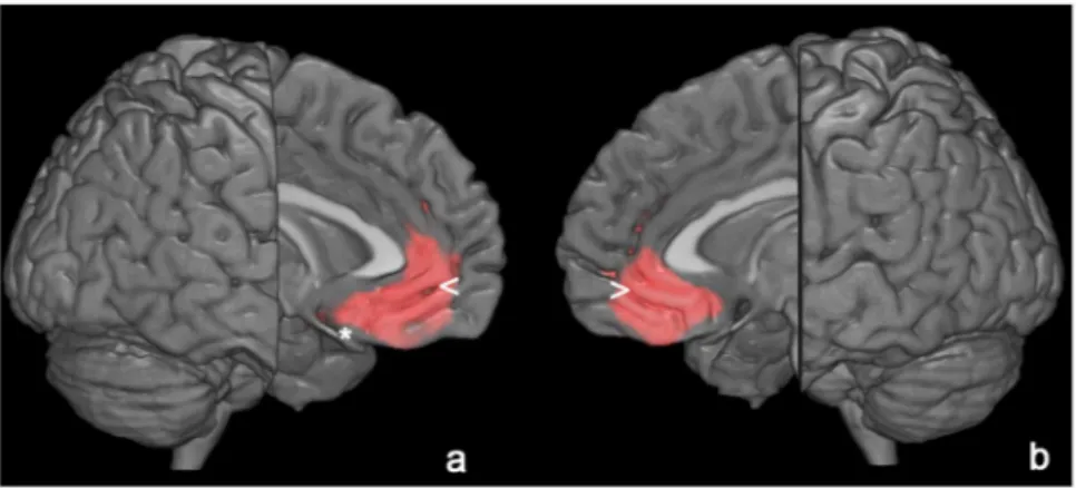 Figure 1.  3D rendering of data presented in Table 3 in (a) showing the positive correlation between TSH and  brain glucose consumption in left anterior cingulate cortex (&lt;) and medial frontal gyrus (*) and in the right  anterior cingulate cortex (b, &g