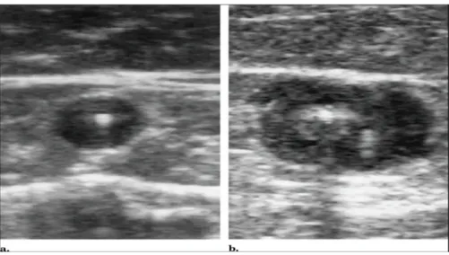 Figure  9.  Duplex  US  (transverse  view)  demonstrating  appearance  of  the  GSV  before  and  after  proper  delivery of tumescent anaesthesia