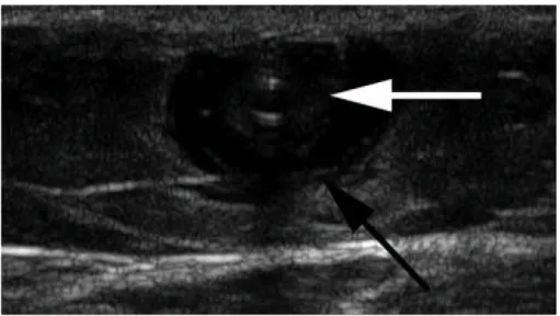 Figure  10.  Fluid  surrounding  the  GSV  after  injection  of  tumescent  anaesthesia  in  the  saphenous                    compartment (black arrow) with collapsed wall (white arrow) of the GSV around the catheter