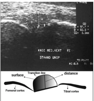 Fig.             6        : L’estrusione meniscale studiata sotto controllo  ecografico in tre posizioni anatomiche differenti 