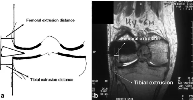 Fig. 5 : Estrusione meniscale laterale studiata con RMN sulla sezione  coronale. 