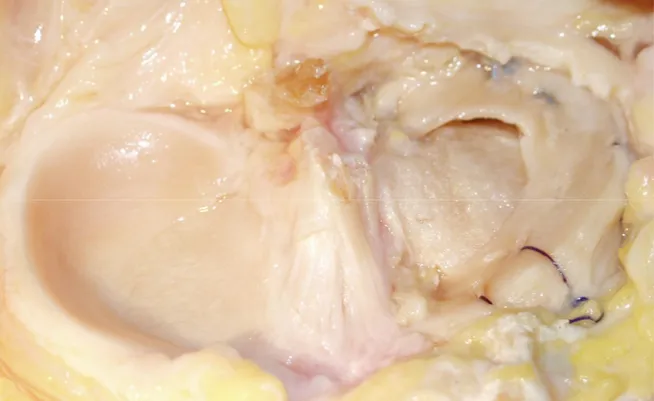 Fig 12 : Sutura dei segmenti medio e anteriore dal terzo filo di  trazione laterale con 3 o 4 suture supplementari mediante tecnica  inside-out sotto controllo artroscopico ed outside-in nella porzione  prossima al corno meniscale anteriore
