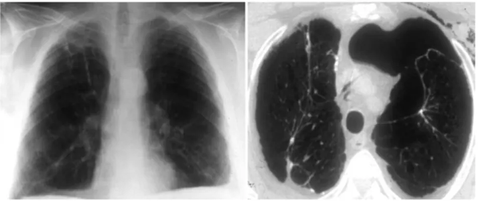 Fig 2. Tomographic feature of a very large right pneumothorax (right), which was  mim-icking lung hyperinflation at scout scanogram (left; slight leftward tracheal shift and  com-pression of the upper lobe vessels).