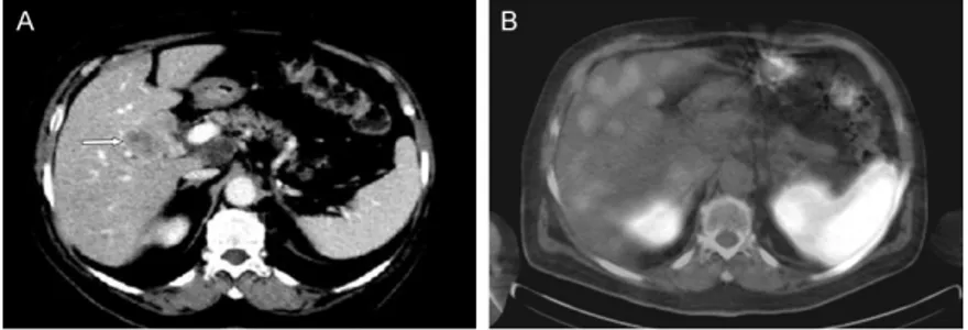 Figure 2. A 74-y-old women with ileal GEP tumor (G3) previously operated and  treated with 3 cycles of chemotherapy with carboplatinum and etoposide