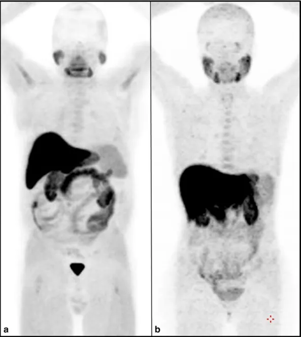 Fig. 1. Maximum intensity projection of two whole body 18 F–choline PET/CT scans respectively performed in a man (a) and in a woman (b)