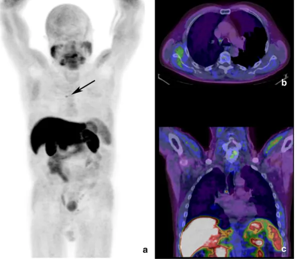 Fig. 2. Maximum intensity projection of the whole body 18 F–choline PET (a) shows single area of focal uptake in the mediastinum, corresponding to a 6 mm wide lymph node in the Barety's space, in corresponding axial (b) and coronal (c) PET/CT views