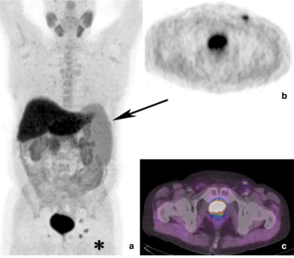 Fig. 3. PET/CT maximum intensity projection (a) shows splenomegaly (black arrow) and intense 18 F–choline uptake in the left inguinal region, with a focal area evident in axial PET detail (b) corresponding to a centimetric lymph node in axial PET/CT view (