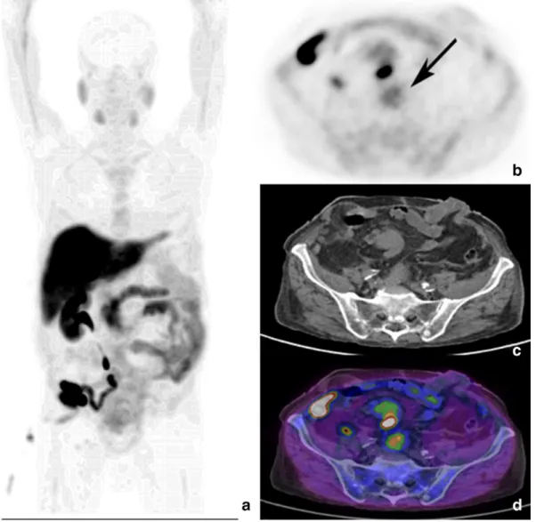 Fig. 4. PET/CT maximum intensity projection (a) of a patient in biochemical relapse of PC after radiotherapy (PSA 1.1 ng/ml), previously also submitted to cystectomy and ileo-cutaneous ureterostomy for bladder carcinoma