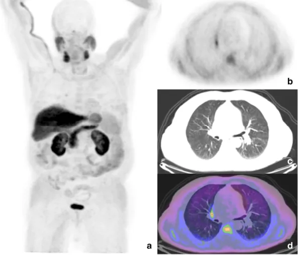 Fig. 5. PET/CT maximum intensity projection (a) and axial PET view (b) show a focal area of 18 F–choline uptake in the right pulmonary hilar region (SUVmax 4.1), corresponding to a 1 cm wide lymph node in axial CT (c) and PET/CT views (d)