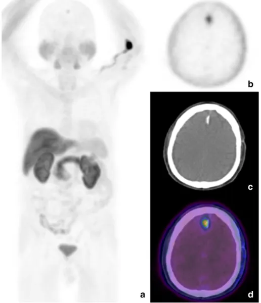 Fig. 6. Maximum intensity projection (a) and axial PET view (b) show focal 18 F–choline uptake in right, parasagittal frontal lobe, corresponding to hyperdense area with calciﬁcations in related CT (c) and PET/CT (d) views