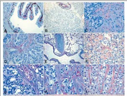 Fig.  7.  Analisi  immunoistochimiche  (IHC)  e  di  immunofluorescenza  in  campioni  in  paraffina per la GSTP e marcatori stromali