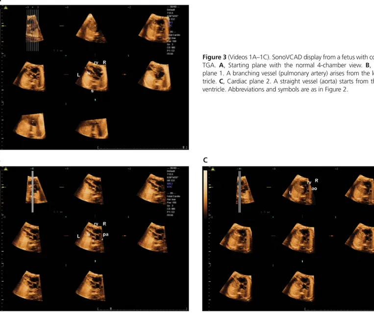 Figure 3 (Videos 1A–1C). SonoVCAD display from a fetus with complete TGA.  A, Starting plane with the normal 4-chamber view