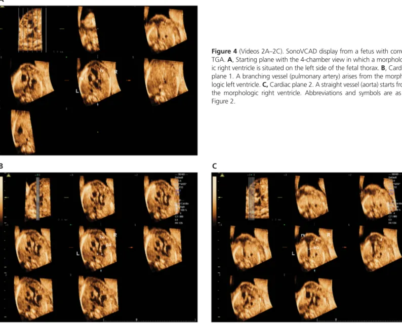 Figure 4 (Videos 2A–2C). SonoVCAD display from a fetus with correct TGA. A, Starting plane with the 4-chamber view in which a  morpholog-ic right ventrmorpholog-icle is situated on the left side of the fetal thorax