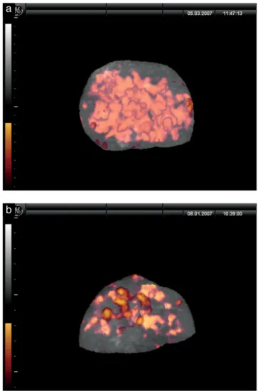 Figure 1 Three-dimensional power Doppler images of the placenta of a euploid fetus (a) and a trisomy 18 fetus (b).