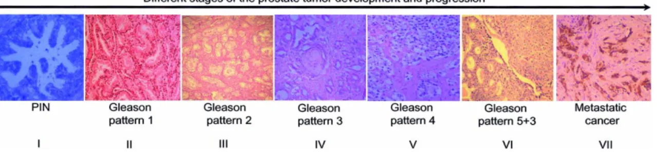 Figura  3.  Stadi  evolutivi  di un  carcinoma prostatico. Pannello  I: lesione  intraepiteliale  (PIN)  di alto grado