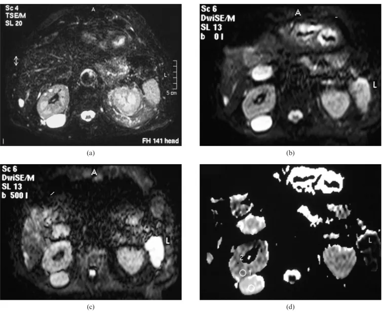 Figure 3. Cyst of the right kidney. (a) Axial turbo spin echo (TSE) T 2 weighted image with fat saturation