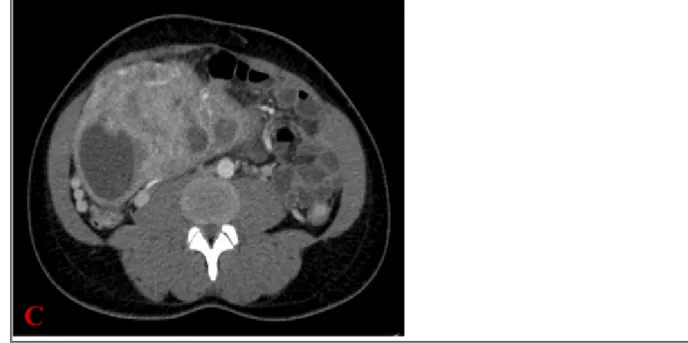 Figure 3 MRI of the abdomen and the pelvis after Gadolinium injection