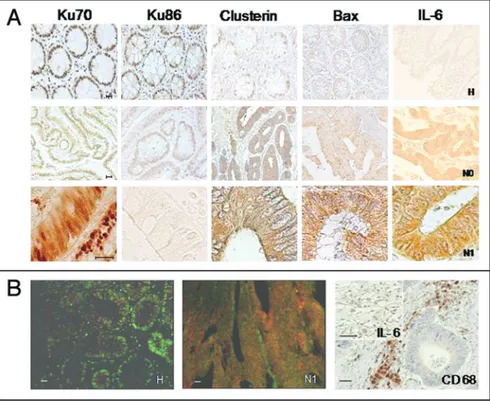 Figure 1. (A) Immunohistochemical analysis of Ku70, Ku86, Clusterin, Bax and IL-6 expression  in normal colonic mucosa (H), node negative (N0) and node positive (N1) colon carcinomas