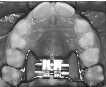 Figure 1. The butterfly rapid maxillary expander.