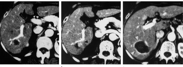 Figure 4. CT scans show residual viable tissue after the procedure. (a) Transverse arterial phase CT scan obtained before LTA shows a hypoat- hypoat-tenuating 2.5-cm-diameter nodular HCC (arrow) in segment 6
